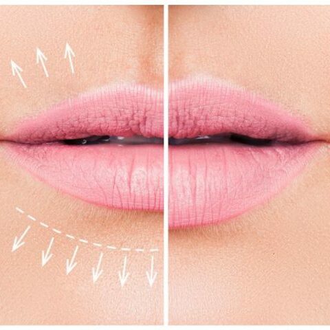 Lippenfiller Hyaluronsäure Vergleich Vorher Nachher